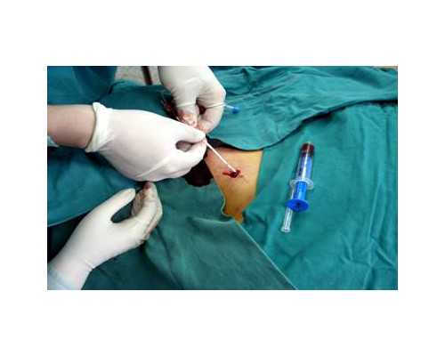 胚胎移植前注意事项清单？多少钱一次！